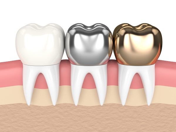 What To Do About A Loose Dental Crown