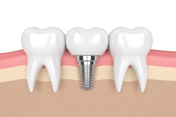 Questions To Ask At Your Dental Implants Consultation
